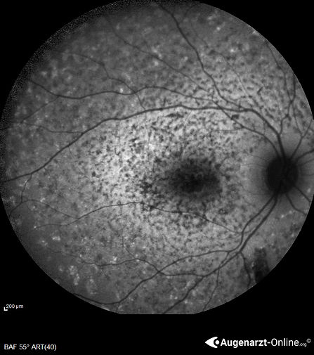 Morbus Stargardt Fundus Flavimaculatus Atlas Der Augenheilkunde Morbus Stargardt Fundus Flavimaculatus Atlas Der Augenheilkunde
